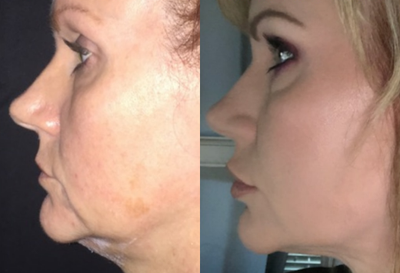 Kybella before and after photo
