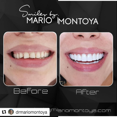 Porcelain Veneers before and after photo