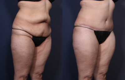 Tummy Tuck before and after photo