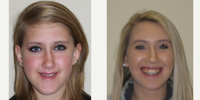 Braces before and after photo