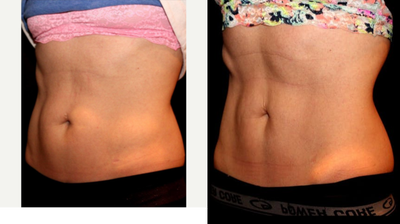 CoolSculpting before and after photo