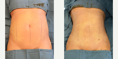 Liposculpture before and after photo