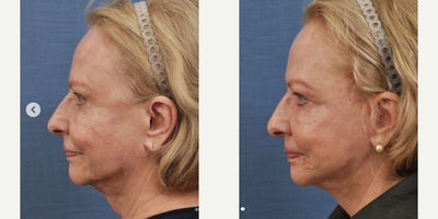 Neck Lift before and after photo