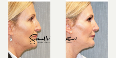 Revision Rhinoplasty before and after photo