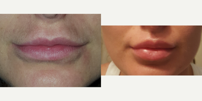 Belotero before and after photo