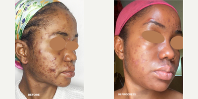 Chemical Peel before and after photo