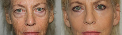 Eyelid Surgery before and after photo