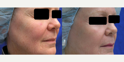 Fractional Laser before and after photo