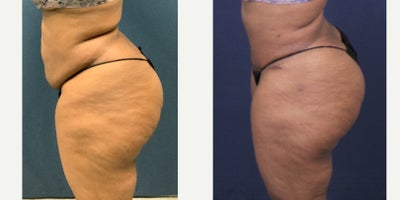 Tummy Tuck before and after photo