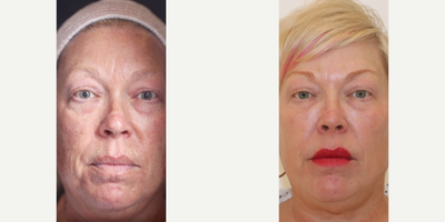 CO2 Laser before and after photo