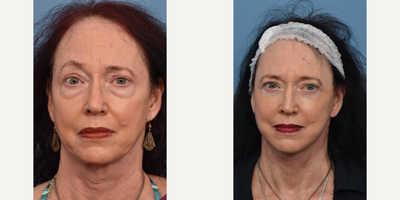 Eyelid Surgery before and after photo