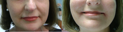 Radiesse before and after photo