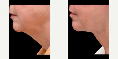 Facelift before and after photo