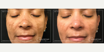 Chemical Peel before and after photo
