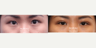Eyelid Surgery before and after photo
