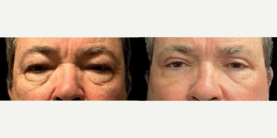 Eyelid Surgery before and after photo