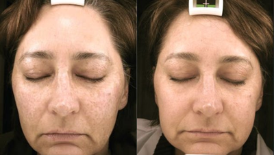 Fractional Laser before and after photo