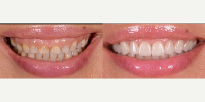 Smile Makeover before and after photo