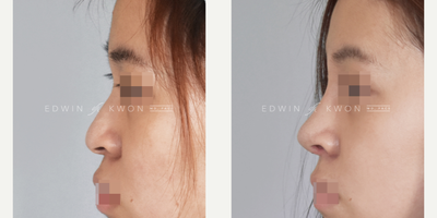 Asian Rhinoplasty before and after photo