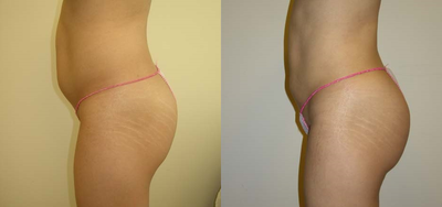 Brazilian Butt Lift before and after photo