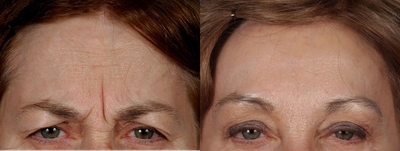 Brow Lift before and after photo
