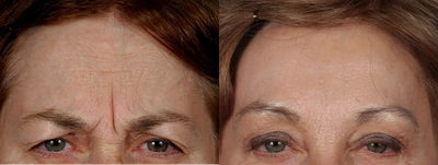 Brow Lift before and after photo