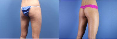 Cellulaze before and after photo