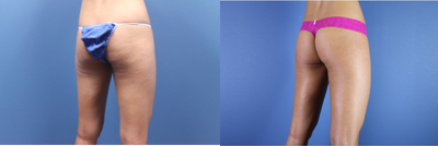 Cellulaze before and after photo