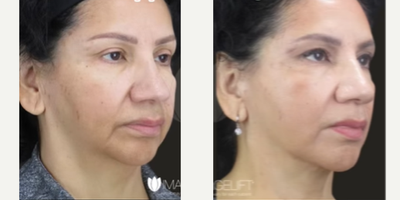 Eyelid Surgery before and after photo