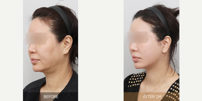 Facelift before and after photo