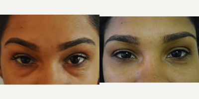 Facial Fat Transfer before and after photo