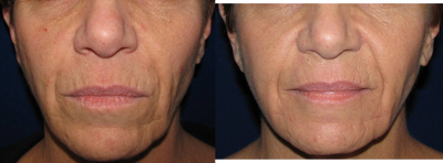 Fraxel Laser before and after photo
