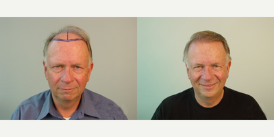 Hair Loss Treatment before and after photo