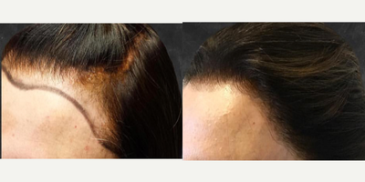 Hair Transplant before and after photo