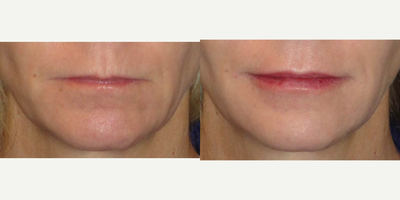Juvederm before and after photo
