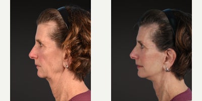 before and after image