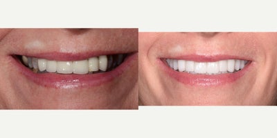 Smile Makeover before and after photo