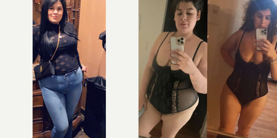 Arm Lift before and after photo