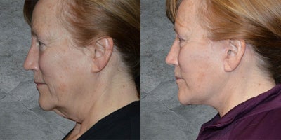 Deep Plane Facelift before and after photo