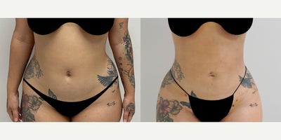 Liposuction before and after photo