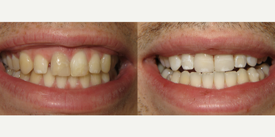 Porcelain Veneers before and after photo