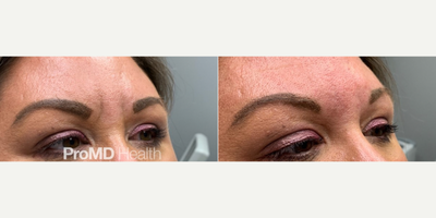 Botox before and after photo