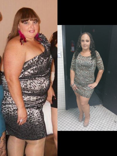 Gastric Bypass before and after photo