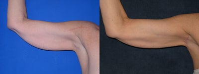 Liposuction before and after photo