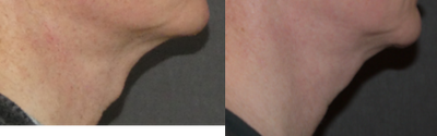 Adam's Apple Reduction before and after photo