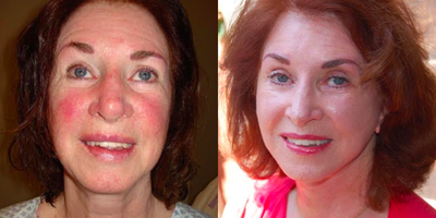 Facelift Revision before and after photo
