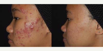 Laser Genesis before and after photo