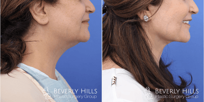 Neck Lift before and after photo