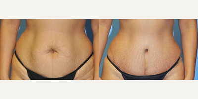 Tummy Tuck before and after photo