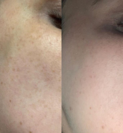 Chemical Peel before and after photo